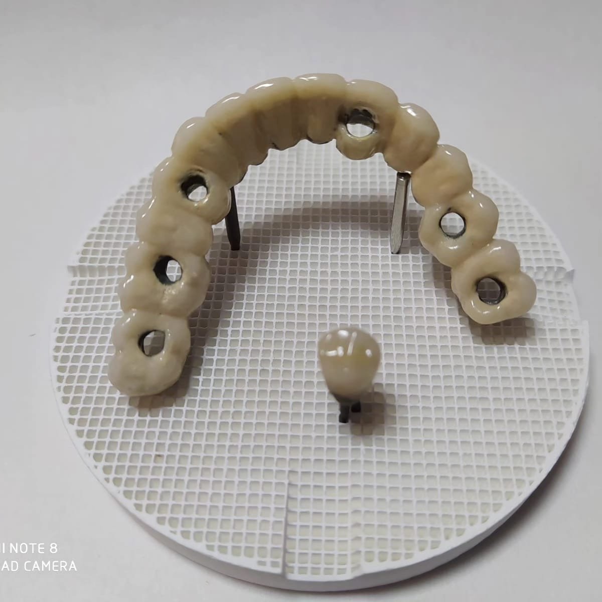 Puente sobre implantes